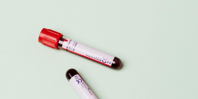 GGT (gama-glutamil transferaza)