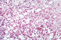 Alkoholni hepatitis