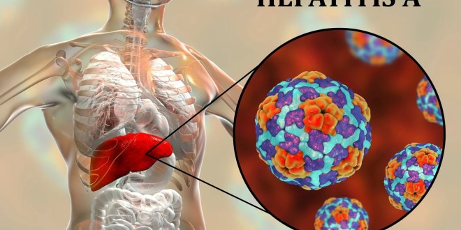 Hepatitis A