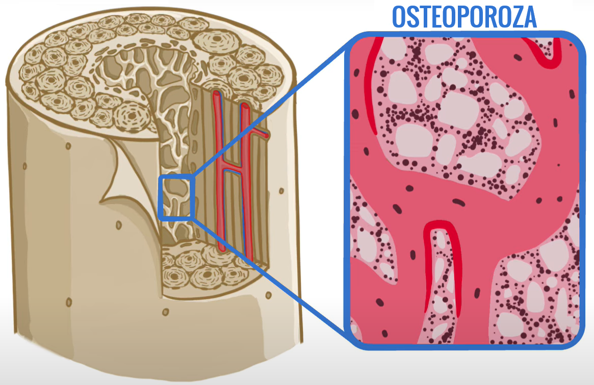 Osteoporoza: Šta je i kako je prepoznati? Detaljan vodič za jake kosti
