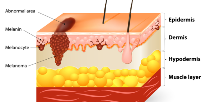 Melanom na koži: Simptomi, izgled i rizične grupe