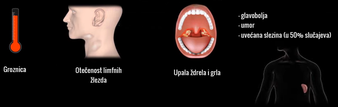 Koji su simptomi mononukleoze