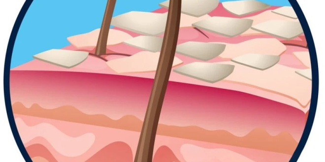 Psorijaza: Uzroci i simptomi