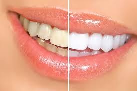 Beljenje zuba pre i posle
